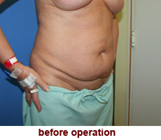 plastic-surgery-tummy-tuck